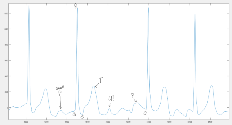 File:AF ECG Annotated Waveform.png